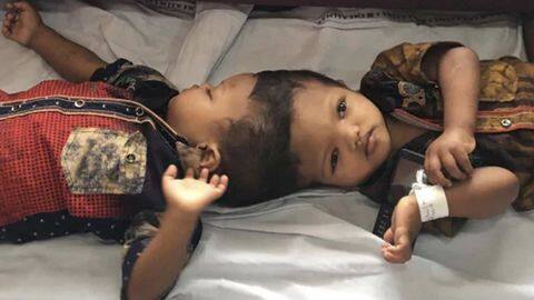ओडिशा के सिर से जुड़े दो बच्चों का हुआ सफल ऑपरेशन, लिम्का बुक में रिकॉर्ड दर्ज ओडिशा के सिर से जुड़े दो बच्चों का हुआ सफल ऑपरेशन, लिम्का बुक में रिकॉर्ड दर्ज