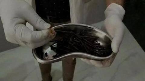 मरीज़ के पेट से निकली 116 लोहे की कीलें और कई चीज़ें, अब पूरी तरह स्वस्थ मरीज़ के पेट से निकली 116 लोहे की कीलें और कई चीज़ें, अब पूरी तरह स्वस्थ
