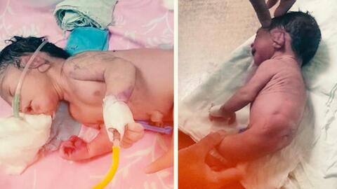 मध्य प्रदेश में जन्मा अनोखा बच्चा, पैरों की जगह सींग जैसी संरचना मध्य प्रदेश में जन्मा अनोखा बच्चा, पैरों की जगह सींग जैसी संरचना