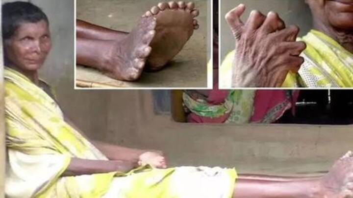 ओडिशा: महिला के पैरों में हैं 20 और हाथों में 12 अंगुलियाँ, लोग मानते हैं चुड़ैल