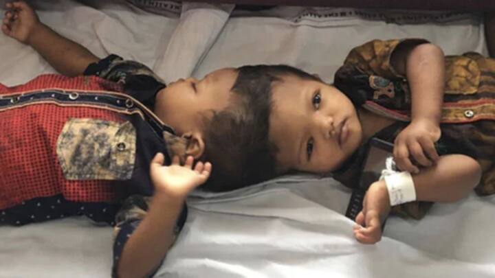 ओडिशा के सिर से जुड़े दो बच्चों का हुआ सफल ऑपरेशन, लिम्का बुक में रिकॉर्ड दर्ज