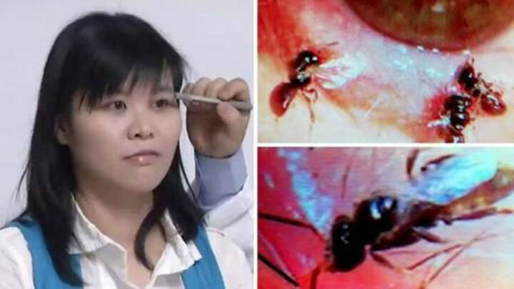 ताइवान: महिला की आँख के अंदर से निकली चार जीवित मधुमक्खियाँ, जानें