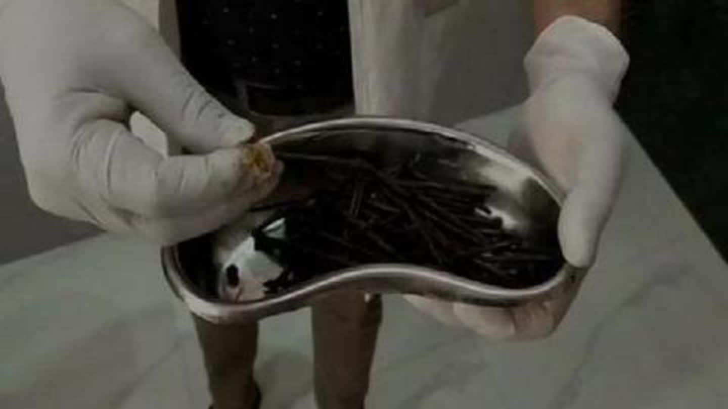 मरीज़ के पेट से निकली 116 लोहे की कीलें और कई चीज़ें, अब पूरी तरह स्वस्थ