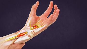 कार्पल टनल सिंड्रोम: जानिए हाथ से जुड़ी इस बीमारी के कारण, लक्षण और बचने के उपाय