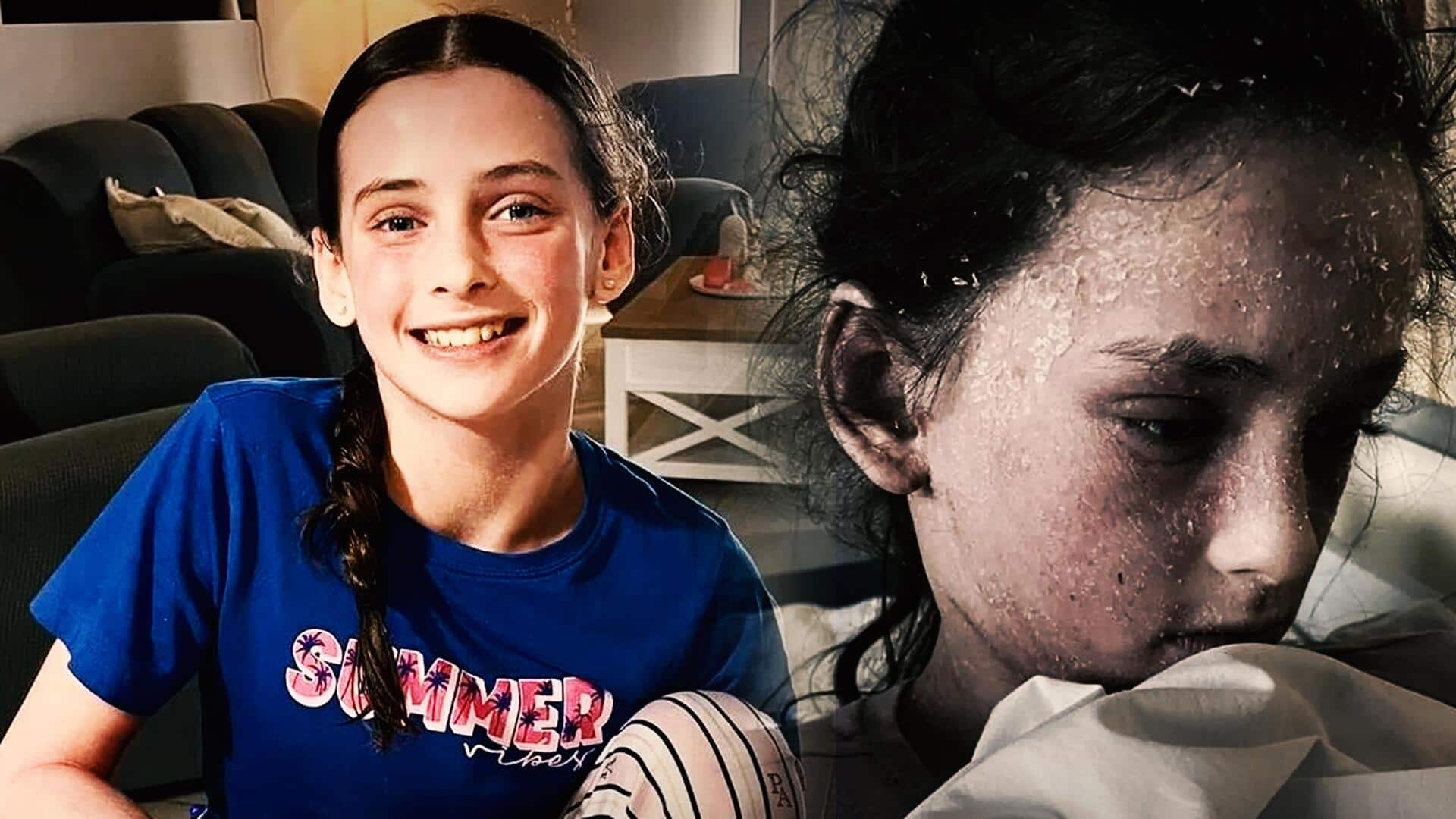ऑस्ट्रेलिया: इस बच्ची को है खतरनाक बीमारी, खुद के आंसू और पसीने से ही है एलर्जी