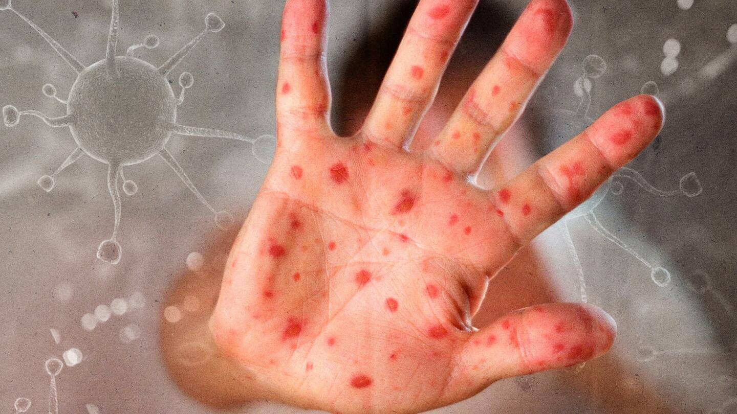 भारत में 82 हुई 'टमाटर फ्लू' के संक्रमितों की संख्या, विशेषज्ञों ने जारी की चेतावनी
