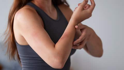 गर्मी और उमस के कारण हो रही हैं घमौरियां? इन घरेलू नुस्खों से मिलेगा आराम