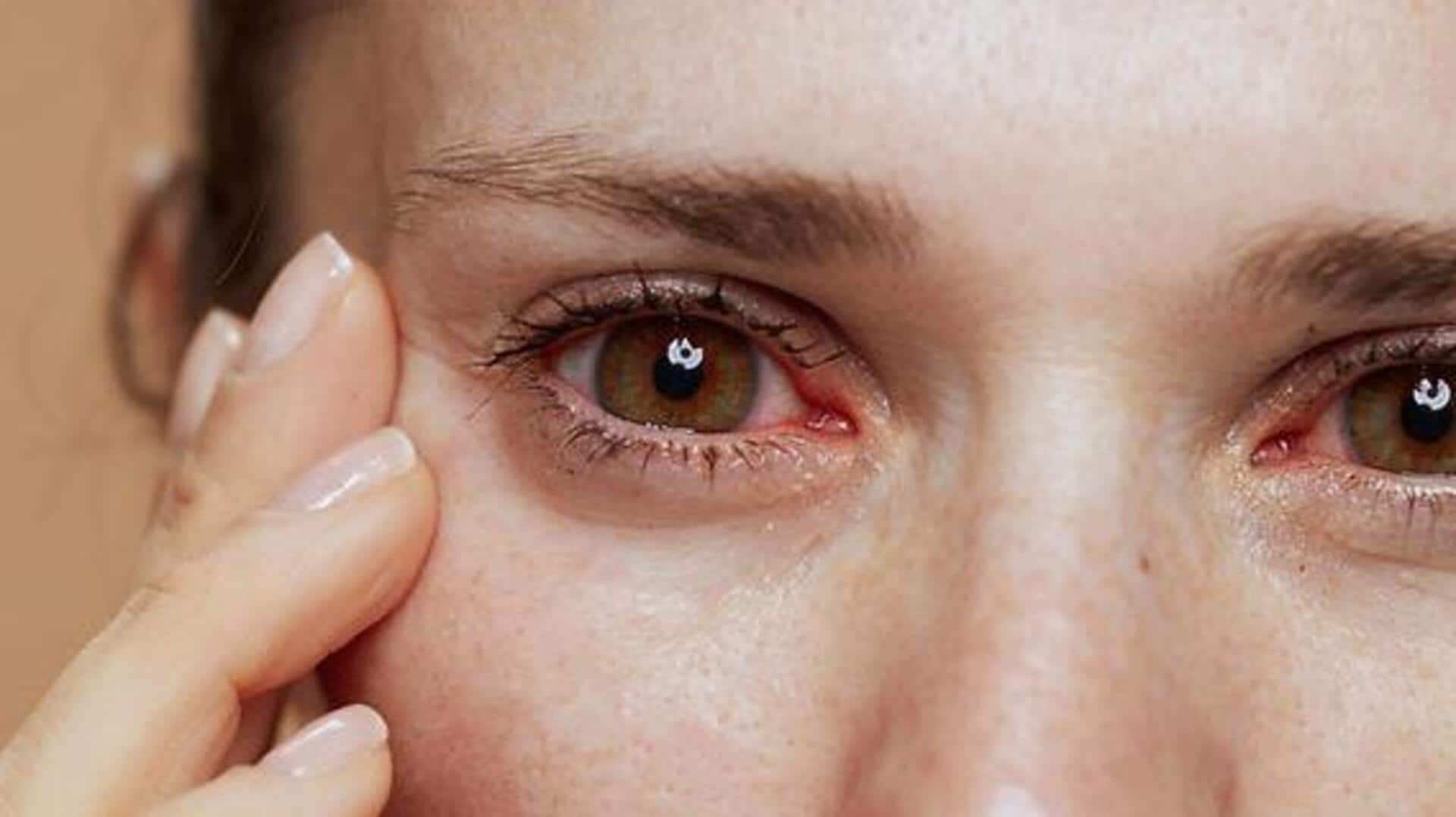 आंखों में एलर्जी? इन 5 घरेलू नुस्खों को आजमाने से मिल सकती है राहत