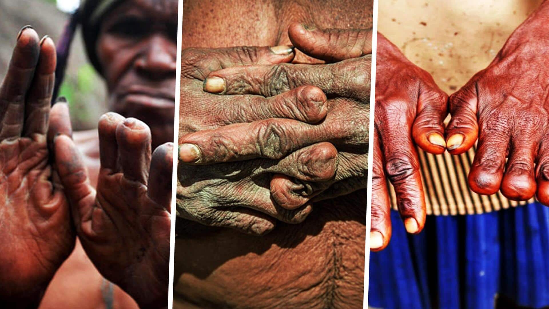 इंडोनेशिया में अजीबोगरीब परंपरा, परिजन की मृत्यु होने पर काट दी जाती हैं महिलाओं की उंगलियां 