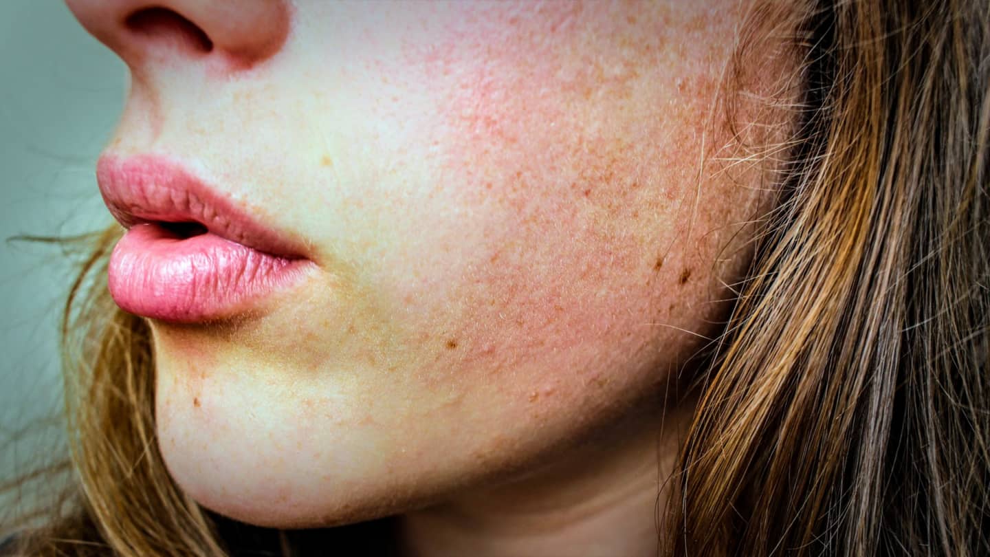 मधुमेह का संकेत देते हैं त्वचा से जुड़े ये लक्षण, भूल कर भी न करें नजरअंदाज