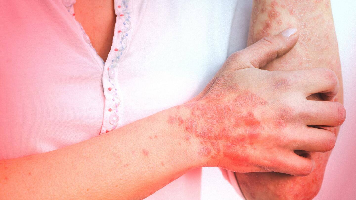 सोरायसिस: जानिए त्वचा से जुड़ी इस बीमारी के कारण, लक्षण और बचाव के उपाय
