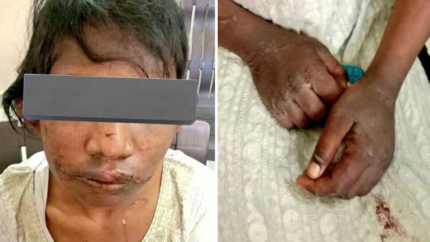 गुरूग्राम: दंपति पर बच्ची को गर्म चिमटे से पीटने और भूखा रखने का आरोप, गिरफ्तार