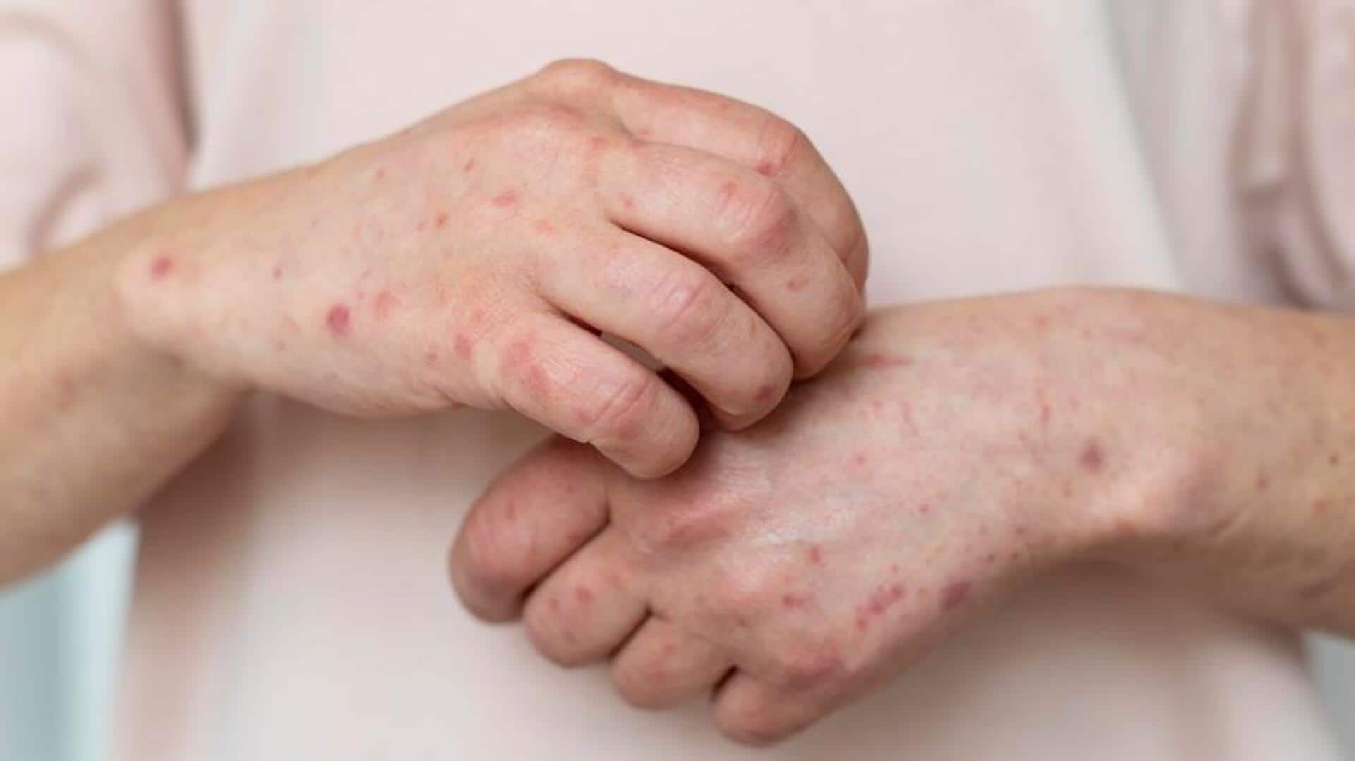 मानसून में होने वाली एलर्जी से राहत पाने के लिए अपनाएं ये 5 घरेलू नुस्खे 