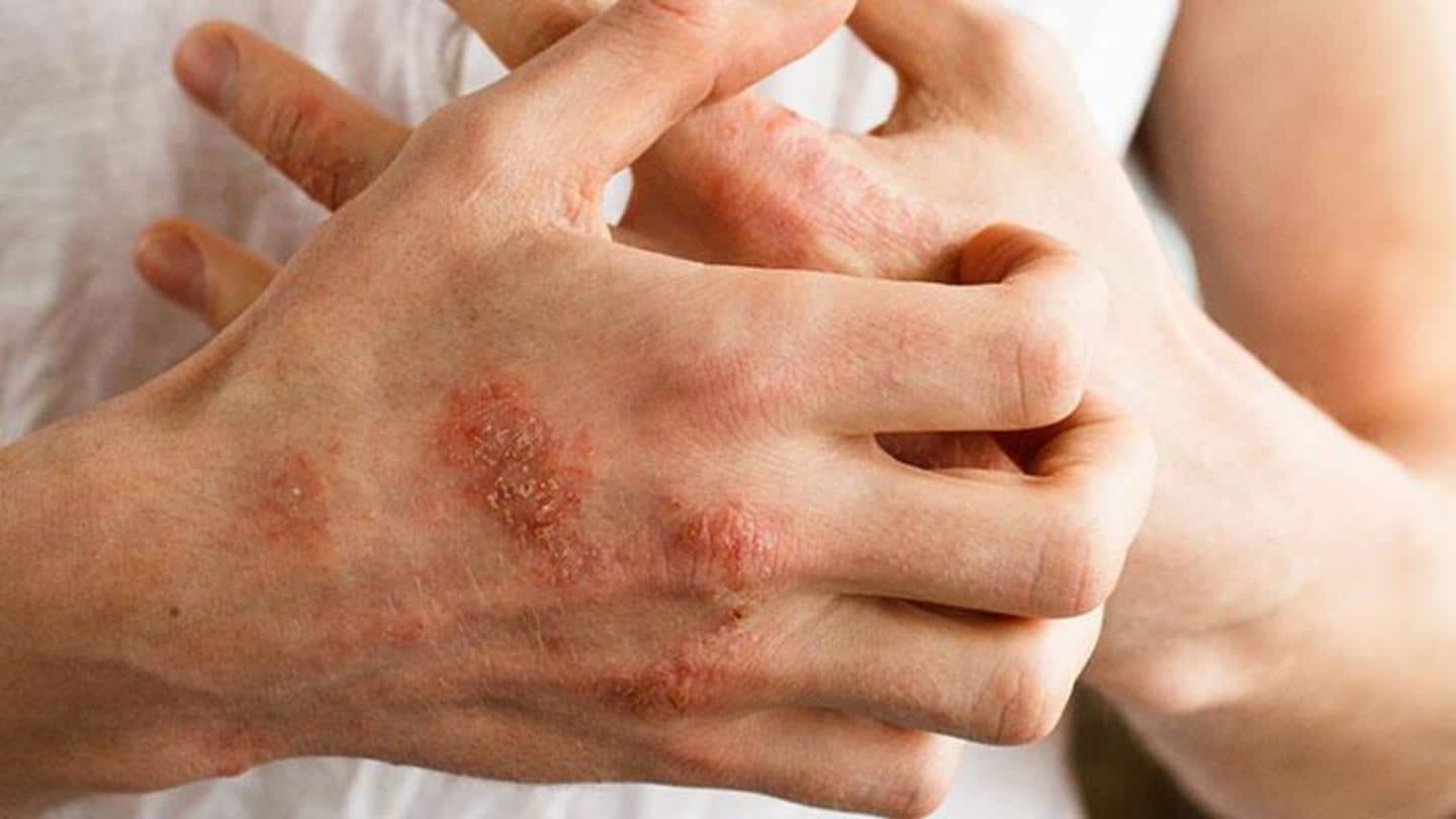 एक्जिमा: जानिए त्वचा से जुड़ी इस बीमारी के कारण, लक्षण और बचाव के उपाय