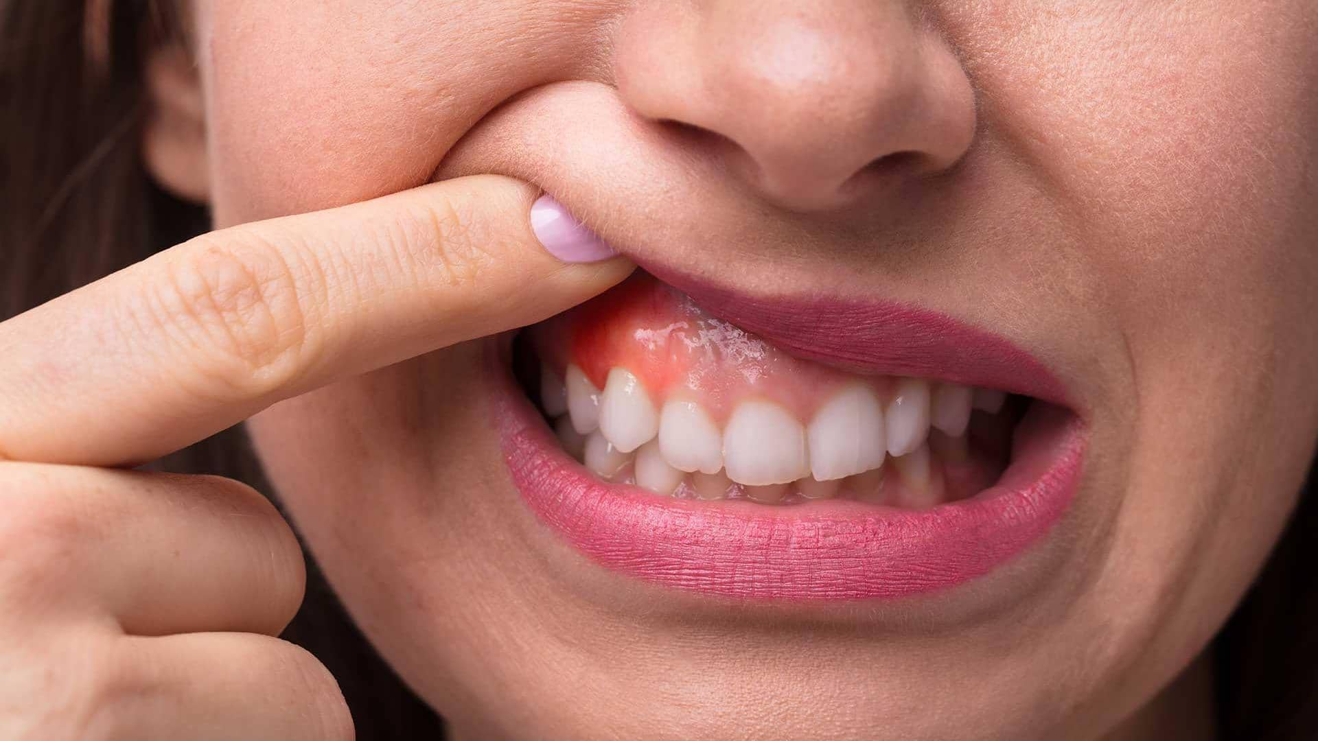 आपके मसूड़ों में होती रहती है खुजली? इन 5 तरीकों से पा सकते हैं राहत 