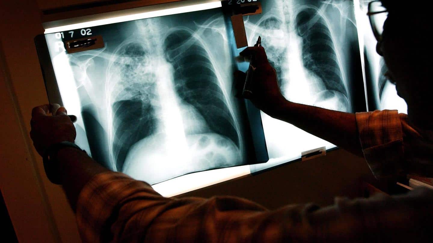 कोरोना संक्रमण के कारण टीबी के मरीजों में इजाफा होने के पर्याप्त सुबूत नहीं- सरकार