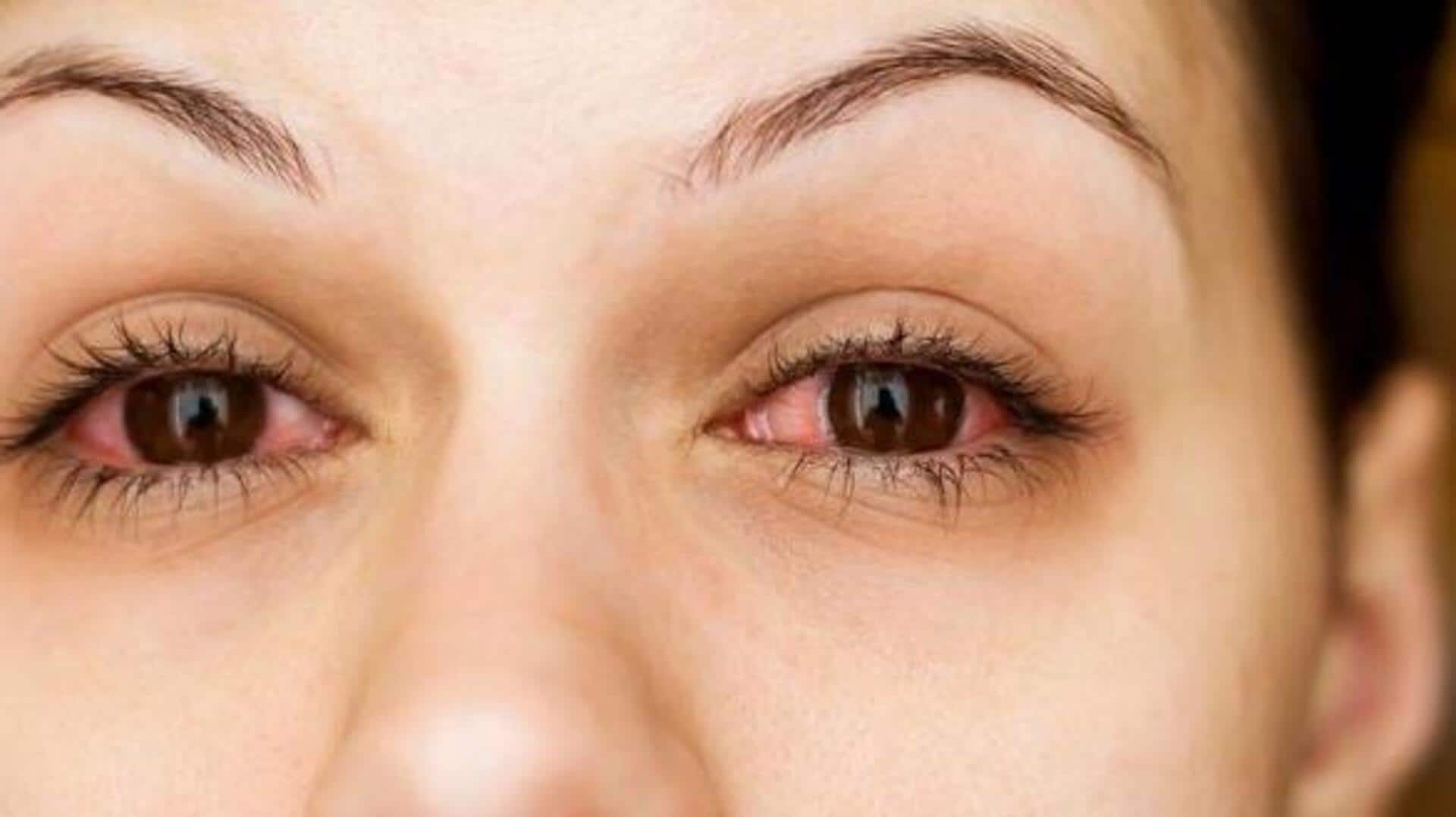 आंखों की लालिमा का कारण बन सकती हैं ये 5 गलतियां, भूल से भी न करें