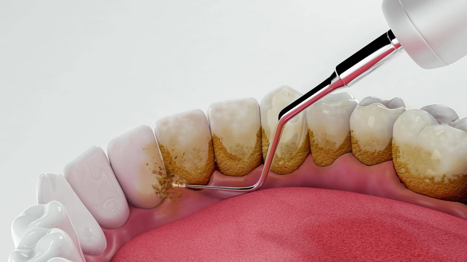 दांतों से प्लाक हटाने के लिए अपनाएं ये 5 असरदार घरेलू नुस्खे