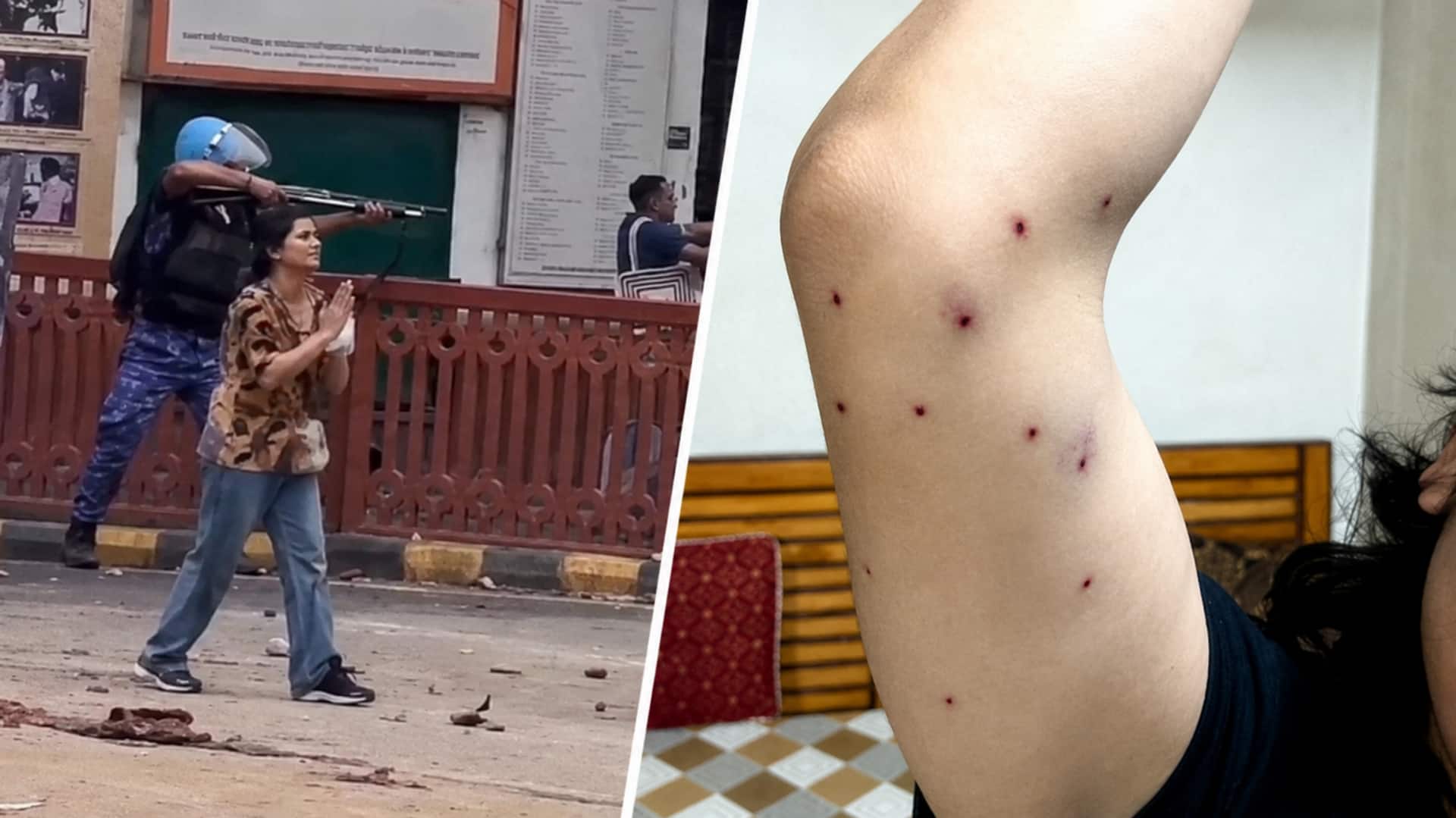 दिल्ली में प्रदर्शनकारी के शरीर से सर्जरी के दौरान निकाले गए धातु के बाहरी पदार्थ- रिपोर्ट