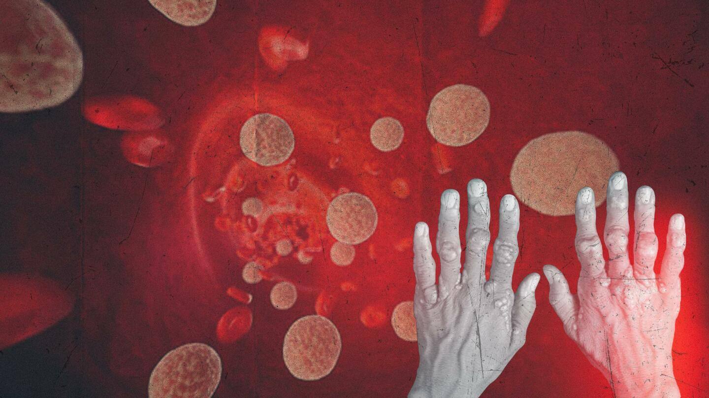 हाइपरकोलेस्ट्रोलेमिया: जानिए खून से जुड़ी इस बीमारी के कारण, लक्षण और बचाव के उपाय