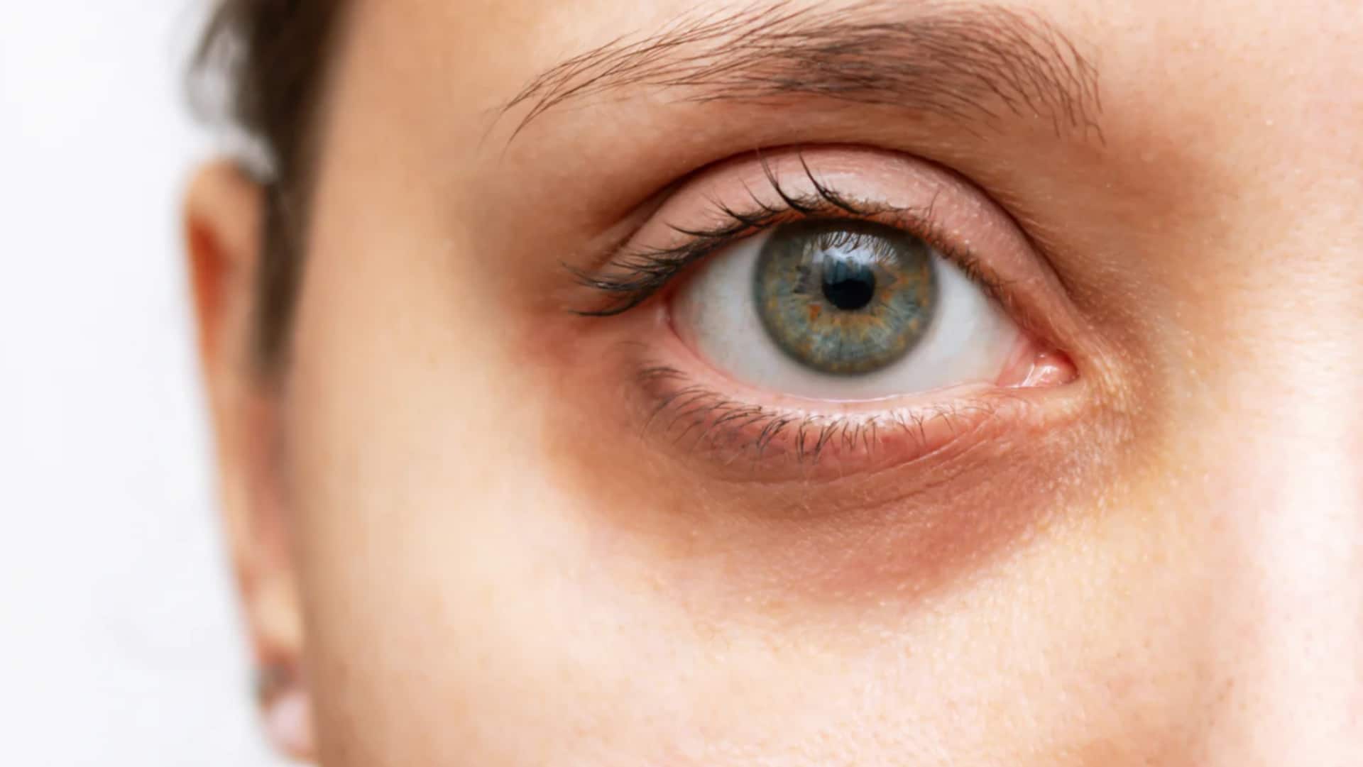 क्या आंखों के नीचे काले घेरे होना स्वास्थ्य के लिए है खतरा? जानिए सच्चाई