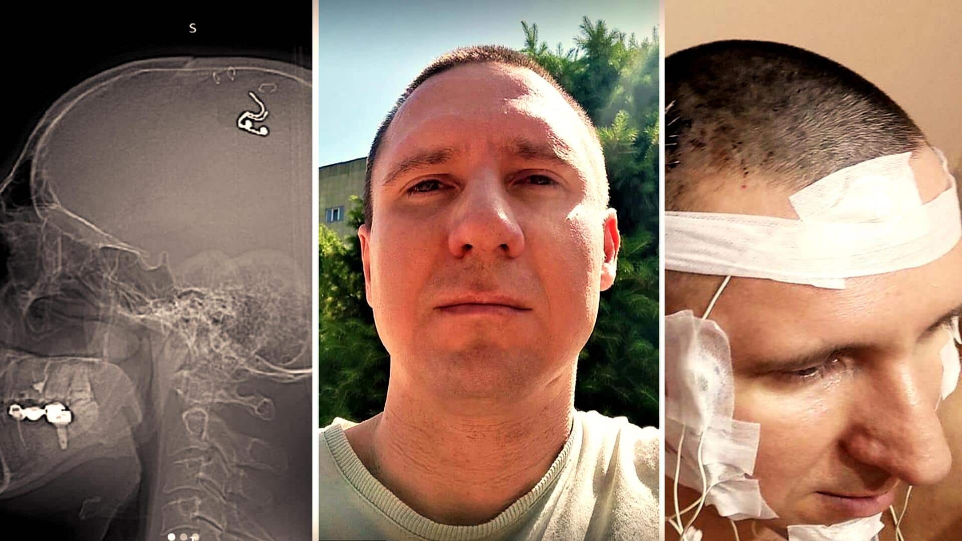 रूस: व्यक्ति ने घर पर सर्जरी कर दिमाग में डाली चिप, सपने नियंत्रित करने की कोशिश