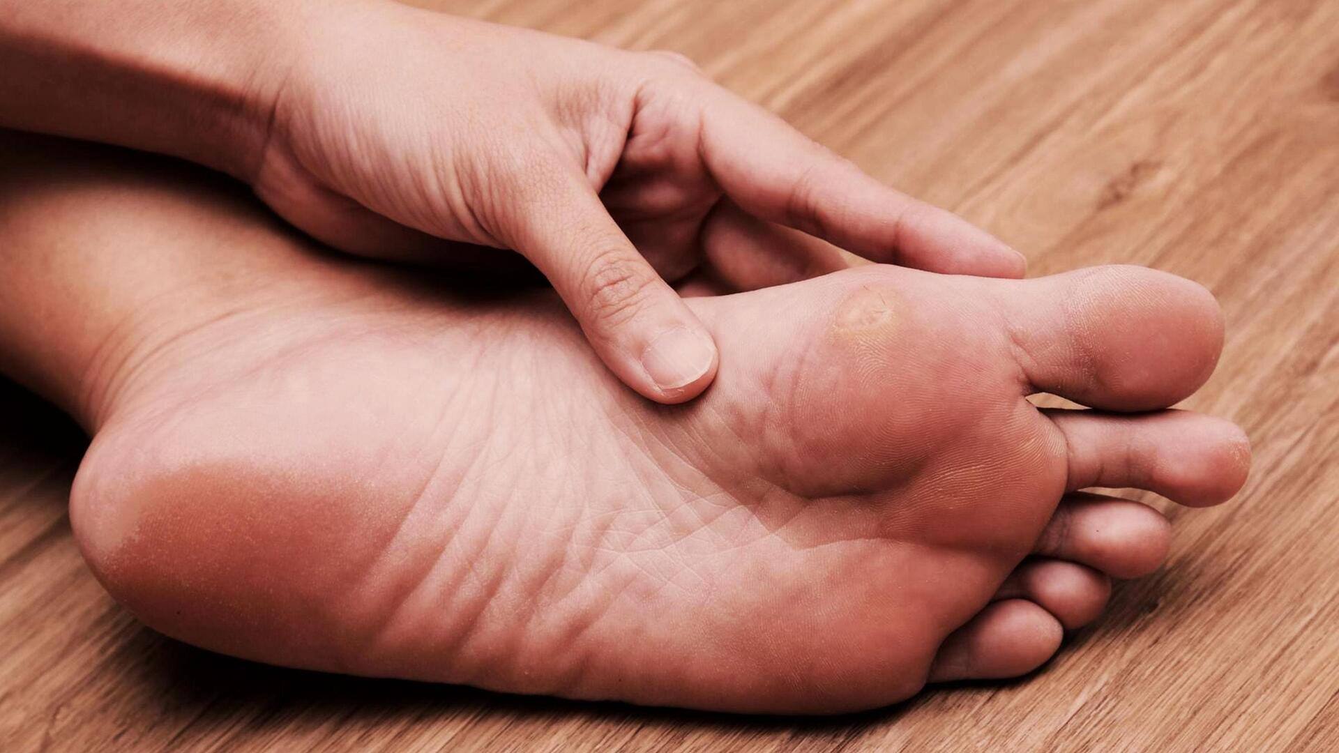 पैर की उंगलियों पर दिखाई देने वाले कॉर्न्स क्या है? जानिए इससे छुटकारा पाने के नुस्खे