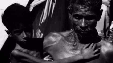 Malnutrition complicating India's severe tuberculosis problem Malnutrition complicating India's severe tuberculosis problem