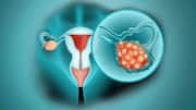 New blood test could detect ovarian cancer in early stages
