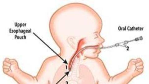 Robot created to treat rare birth defect affecting food pipe Robot created to treat rare birth defect affecting food pipe