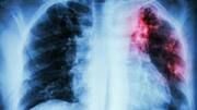 'Hungama to End TB' campaign launched in Odisha's Berhampur
