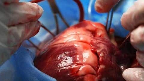 Heart travels from Bengaluru to Kolkata within four-hours, for transplant Heart travels from Bengaluru to Kolkata within four-hours, for transplant