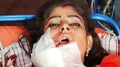 UP: Dancer, shot for stopping performance, will need multiple surgeries UP: Dancer, shot for stopping performance, will need multiple surgeries