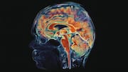 Perelman study finds amyloid clearance may slow Alzheimer's progression