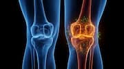 Yale study suggests lacosamide eases osteoarthritis pain and repairs cartilage