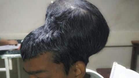 Mumbai: World's largest 1.8-kg tumor removed from man's brain Mumbai: World's largest 1.8-kg tumor removed from man's brain