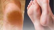 Rice flour for cracked heels? Here's the truth