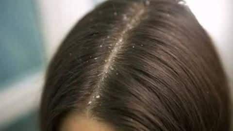 Health Bytes: Five food items that help cure dandruff Health Bytes: Five food items that help cure dandruff