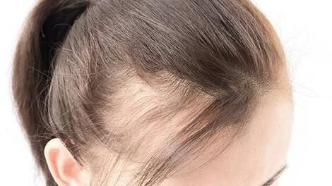 Causes of hair loss: Heredity, Medication, Stress