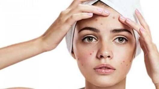 Summer acne: Treatment and home remedies