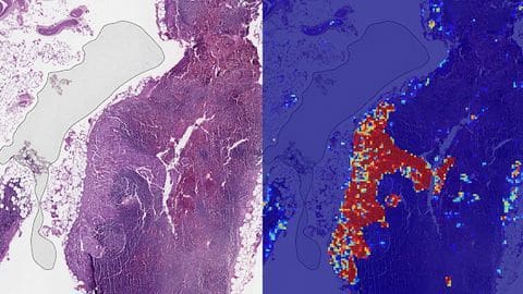 New DeepMind AI-Augmented Cancer Detection Study Detailed
