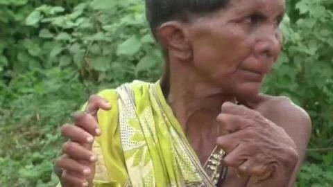 Odisha woman branded 'witch' for having 12 fingers, 20 toes Odisha woman branded 'witch' for having 12 fingers, 20 toes