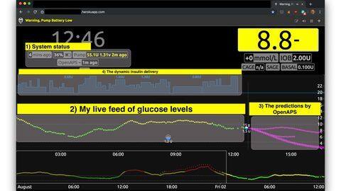 How did he build the 'artificial pancreas'? How did he build the 'artificial pancreas'?