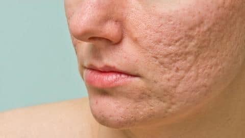 #HealthBytes: Home remedies that can lighten stubborn acne scars #HealthBytes: Home remedies that can lighten stubborn acne scars