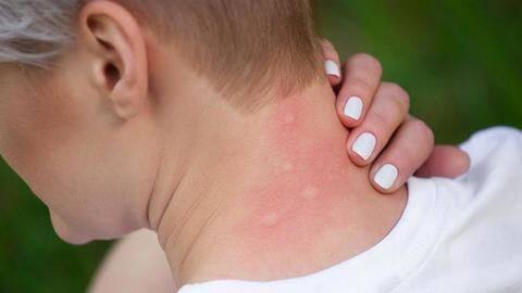 Home remedies for treating mosquito bites Home remedies for treating mosquito bites