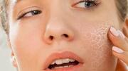 Food items that can help you prevent dry skin