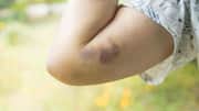 These home remedies may bring relief to forearm bruises