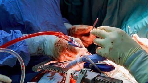 Hyderabad doctors perform cutting-edge 'breathing lung transplant' Hyderabad doctors perform cutting-edge 'breathing lung transplant'