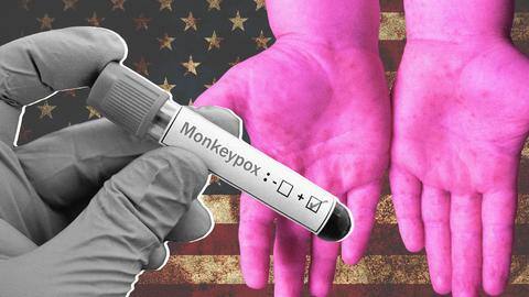 Monkeypox: 31 children test positive in US, Texas worst hit Monkeypox: 31 children test positive in US, Texas worst hit