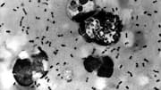 Understanding pneumonic plague: What is it, how dangerous is infection